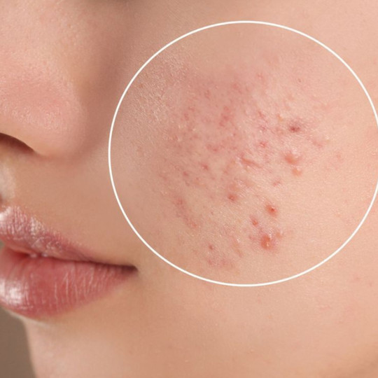 جوش و آکنه چیست؟ دلایل ایجاد جوش و راههای مراقبت از پوست
